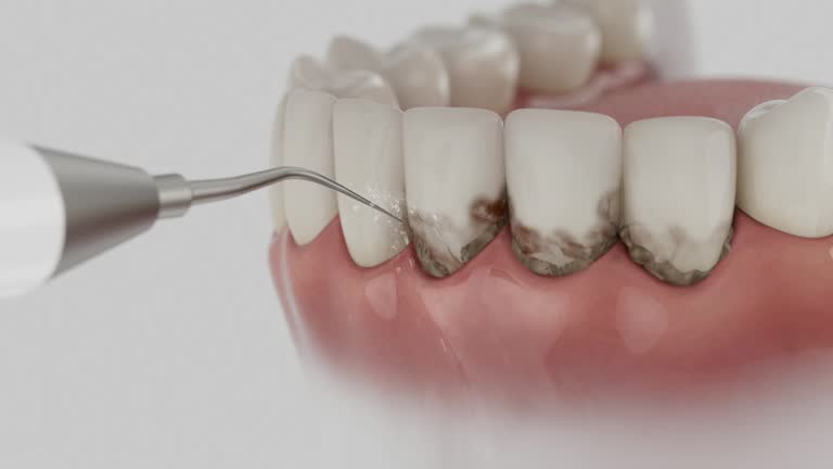 Reliable Dental Implants contractor in Aberdeen, IN by Smile Center Dentistry
